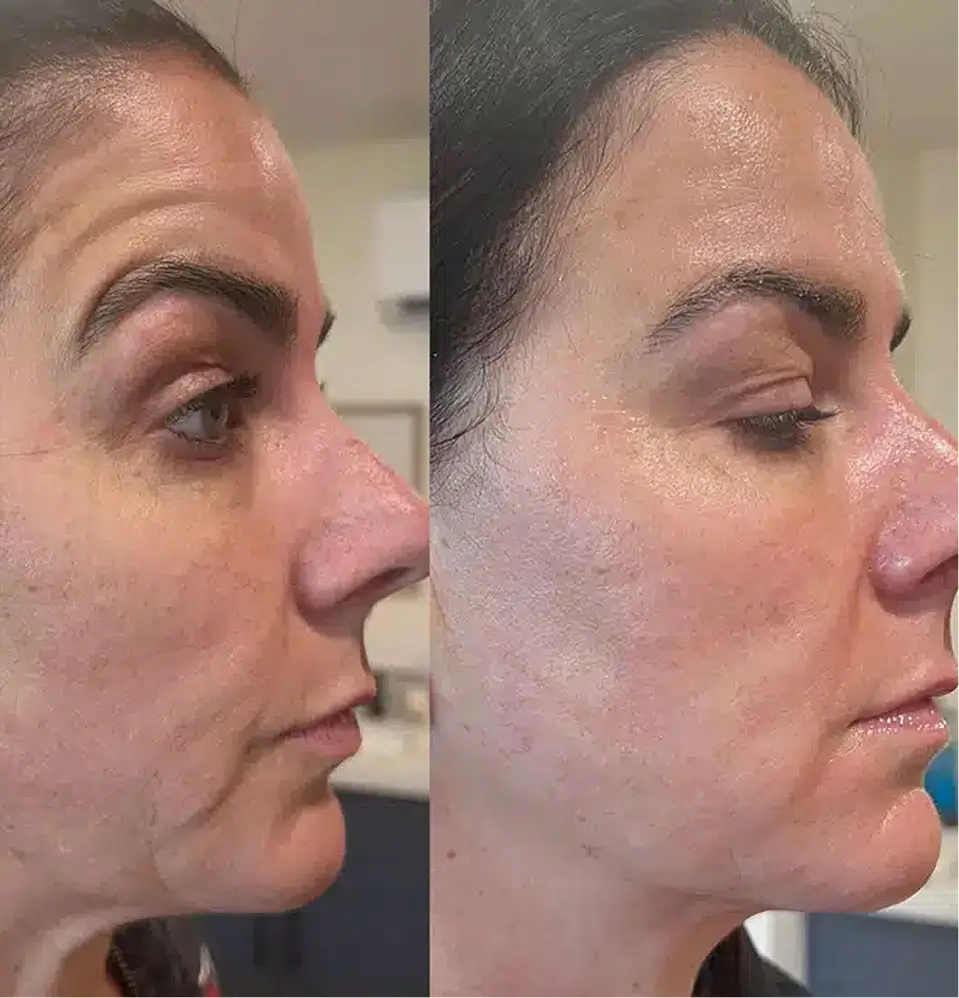 Cool Jett Facial Rejuvenation