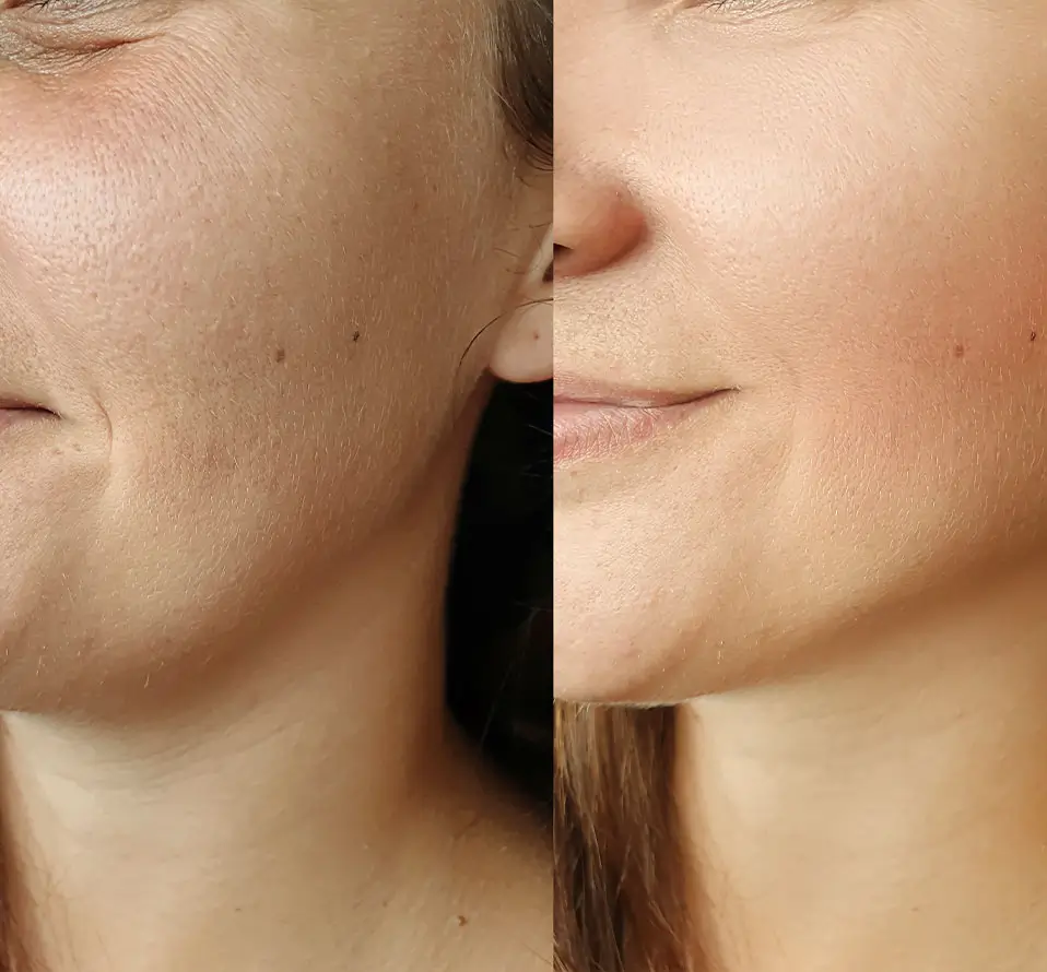 ADVANCED PEEL TECHNOLOGY