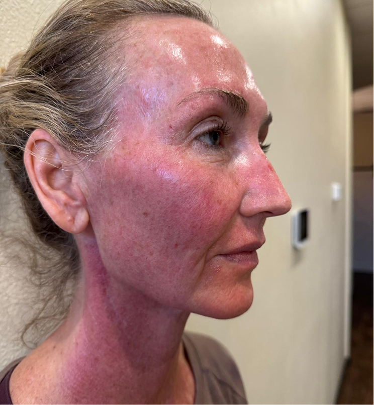 Mild redness for 24–72 hours